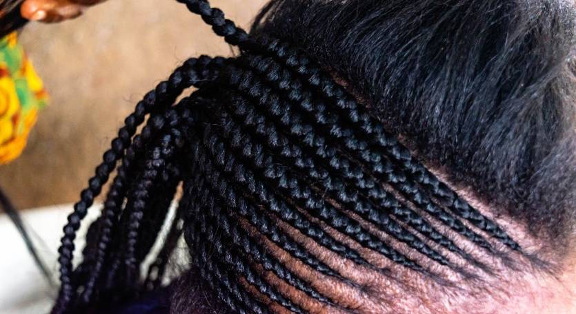 Beware of traction alopecia